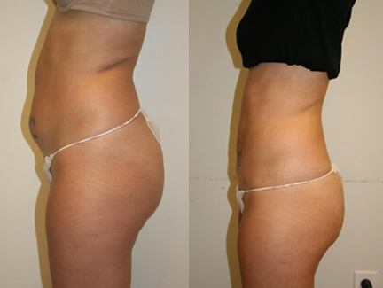 tummy tuck results